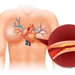 Koroner Arter Hastalığı Nedir